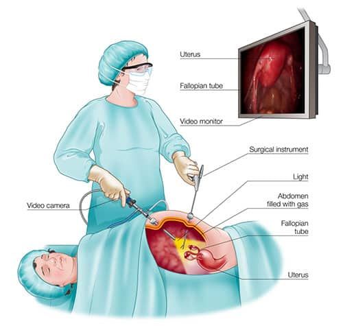 Laparoscopic Endometriosis Surgery